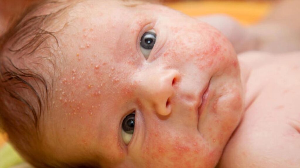 İsilik Neden Olur???