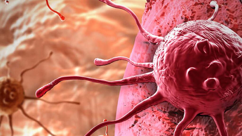 Lenf Kanseri (Lenfoma) Belirtileri Nelerdir..?